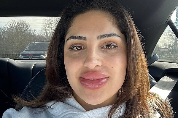 24 yaşındaki Kimia Awazi isimli bir kadın popüler ve uygun fiyatlı bir klinikte dudak dolgusu eritme işlemi yaptırmak istedi.